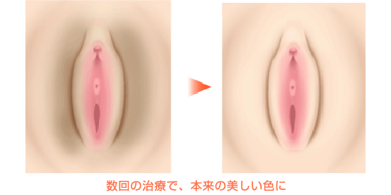 黒ずみ 性器