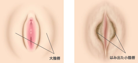 しょういんしん縮小手術 小陰唇縮小手術