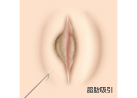 施術イメージ