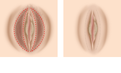 大陰唇肥大手術 縮小術 ガーデンクリニック 美容整形 美容外科