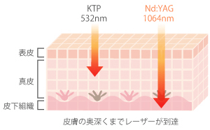 置く深くまでレーザーが到達