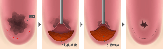 膣壁形成