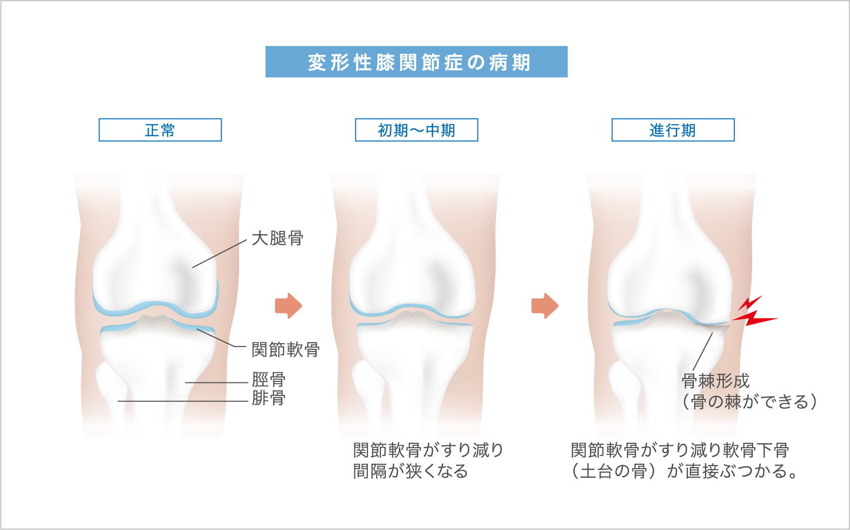 変形性膝関節症の病期