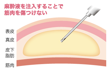 挿入したカニューレの筋肉との接触