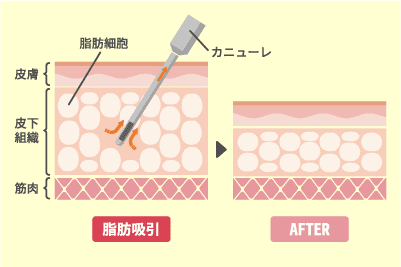脂肪吸引とは?