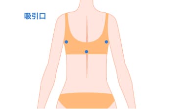 切開の場所と大きさについて