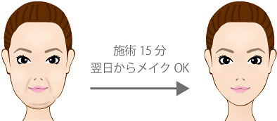 施術15分 翌日からメイク可能