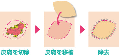 皮膚移植