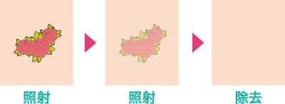 レーザー治療