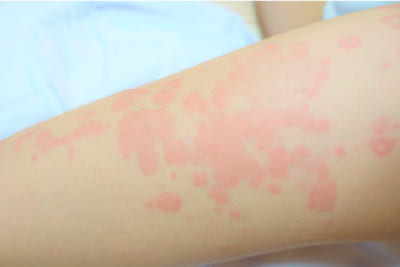 失敗事例1　細菌感染が起こる