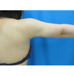 柴田智一医師による二の腕・二の腕付け根の脂肪の吸引　術後