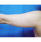 清水三嘉医師による二の腕・二の腕付け根の脂肪の吸引　術前