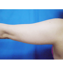 清水三嘉医師による二の腕・二の腕付け根の脂肪の吸引　術前