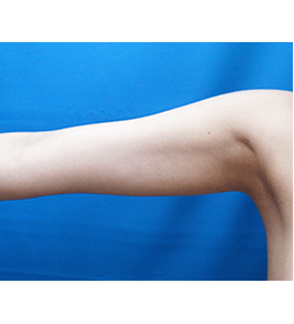 清水三嘉医師による二の腕・二の腕付け根の脂肪の吸引　術後
