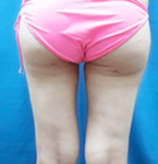 No.L-L0069　術後
