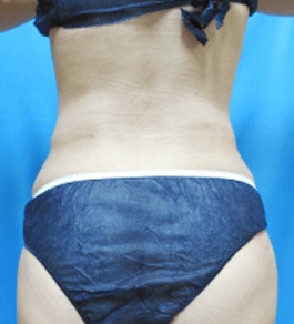治療後のお腹症例写真