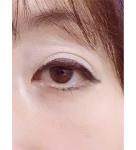目の下のくま・たるみ治療 術後