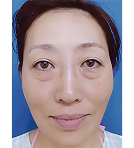 目の下のくま・たるみ治療 術前
