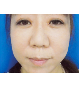 清水三嘉医師によるお顔のエイジングケア 術後