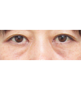 目の下のくま・たるみ治療　術前