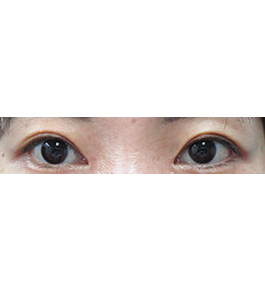 眼の美容整形　術後