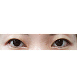 眼の美容整形　術前