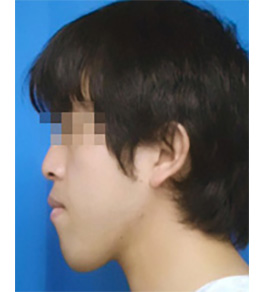 脂肪吸引 治療前の顎症例写真