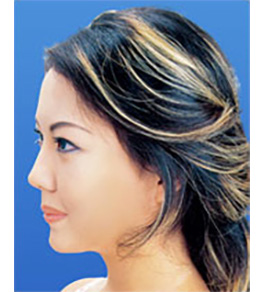 鼻の美容整形 術後
