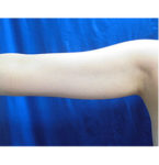 二の腕・二の腕付け根の脂肪の吸引　術前