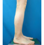 脚(足)の脂肪の吸引　術後