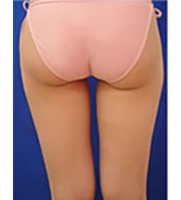 脚(足)の脂肪の吸引 術前