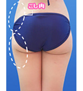 治療後の太もも症例写真