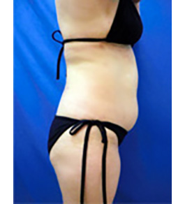 治療前のお腹症例写真