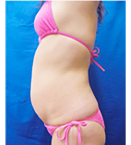 治療前のお腹症例写真