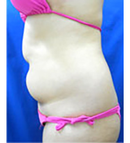 治療前のお腹症例写真