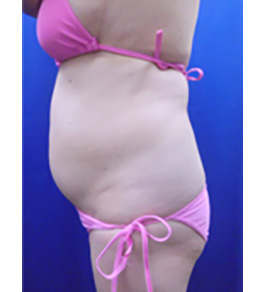 治療前のお腹症例写真