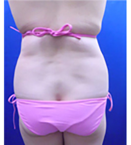 治療前のお腹症例写真