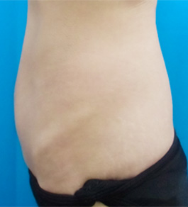 治療後のお腹症例写真
