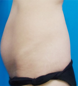 治療前のお腹症例写真