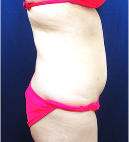 治療前のお腹症例写真