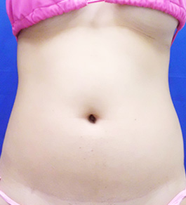 治療前のお腹症例写真