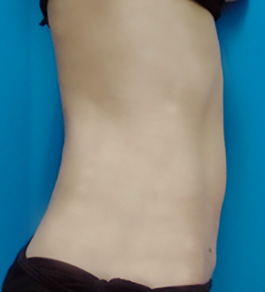 治療後のお腹症例写真