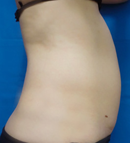 治療前のお腹症例写真