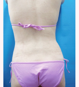 治療後のお腹症例写真