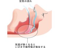 いびきの原因について