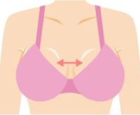 豊胸手術後、胸の谷間が離れてしまった