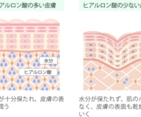 頬のたるみを改善するヒアルロン酸注射