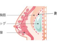 豊胸手術後の胸が痛い