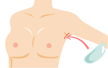 目立たない豊胸手術の傷跡とは ガーデンクリニック 美容整形 美容外科