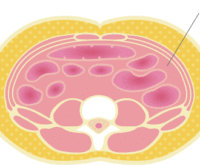 col-liposuction-021